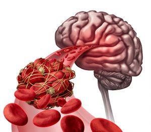 درمان لخته خون در مغز بصورت گیاهی و موثر