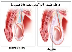 درمان آب آوردن بیضه ها یا هیدروسل