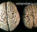 درمان کوچک شدن مغز / آتروفی مغزی