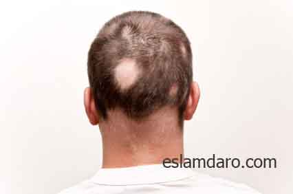 درمان ریزش سکه ای موی سر