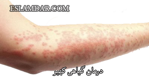 درمان کهیر بصورت گیاهی