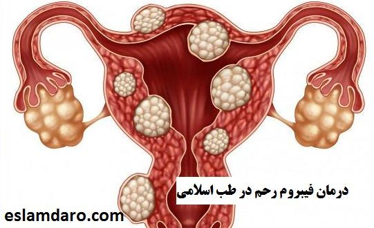 درمان فیبروم رحم