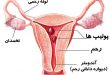 درمان گیاهی پولیپ رحم