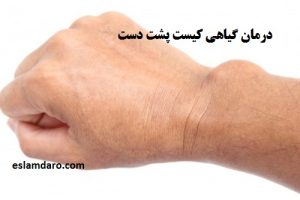 درمان طبیعی کیست مچ دست