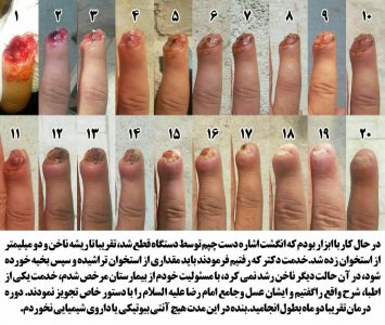 رشد انگشت قطع شده در طب اسلامی