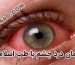 درمان چشم درد