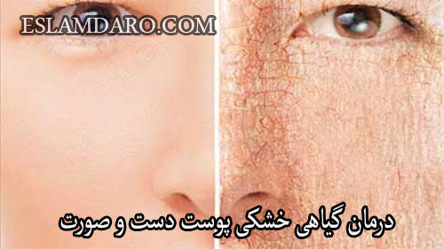 درمان گیاهی خشکی پوست دست و صورت