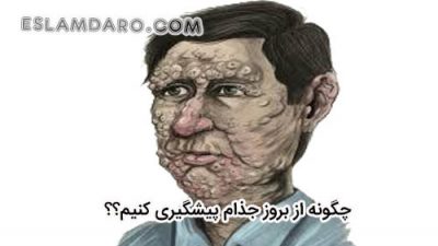 طبق روایات چگونه از بروز جذام پیشگیری کنیم؟؟