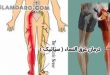 درد سیاتیک و عرق انساء