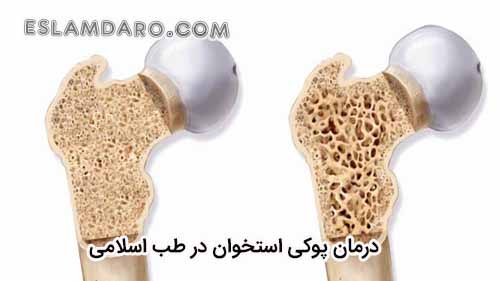 درمان پوکی استخوان در طب اسلامی
