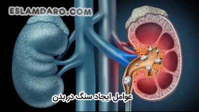 عوامل تولید سنگ در بدن از نگاه طب اسلامی