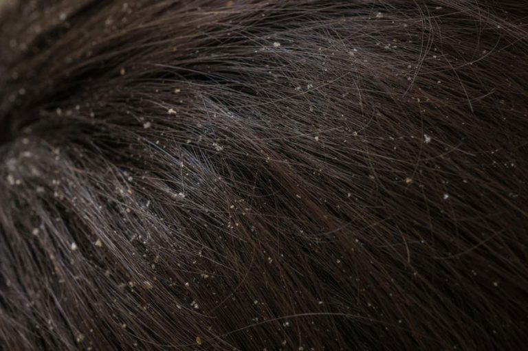 درمان شوره سر در طب اسلامی