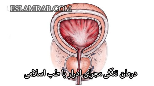 تنگی مجرای ادرار
