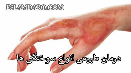 درمان طبیعی انواع سوختگی ها