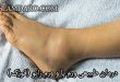 درمان طبیعی ورم پا و ورم زانو (قوزک)