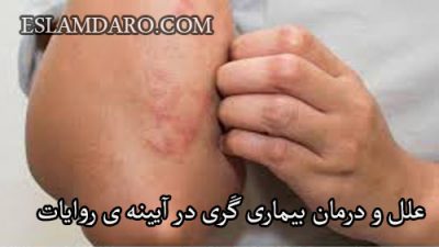 علل و درمان بیماری گَری در آیینه ی روایات